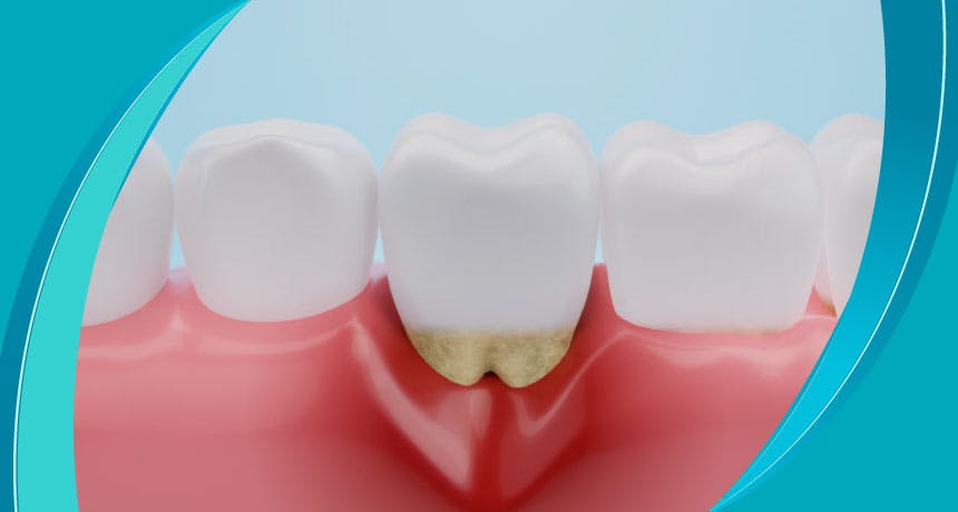 What is Gum Swelling?  