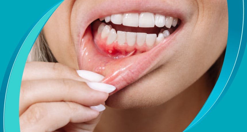 What is a Tooth Lesion?  