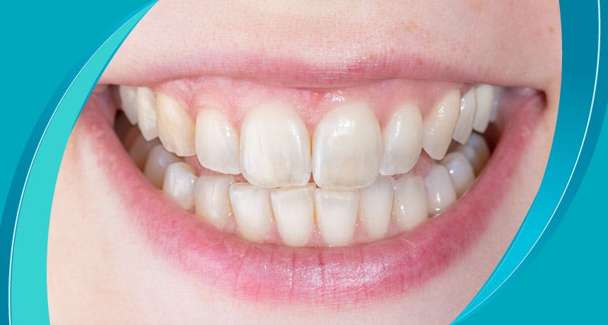 Why Does Tooth Transparency Occur?  