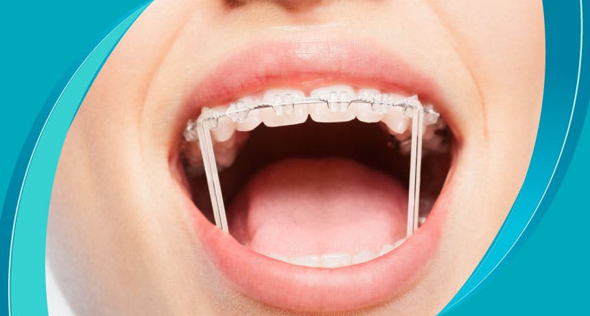 ما هو إطار تقويم الأسنان؟
