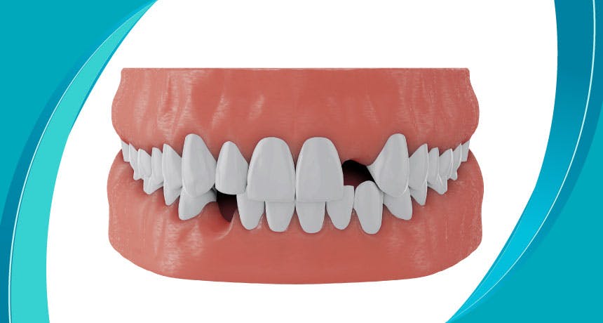Konjenital (Doğuştan) Diş Eksikliği Nedir?  
