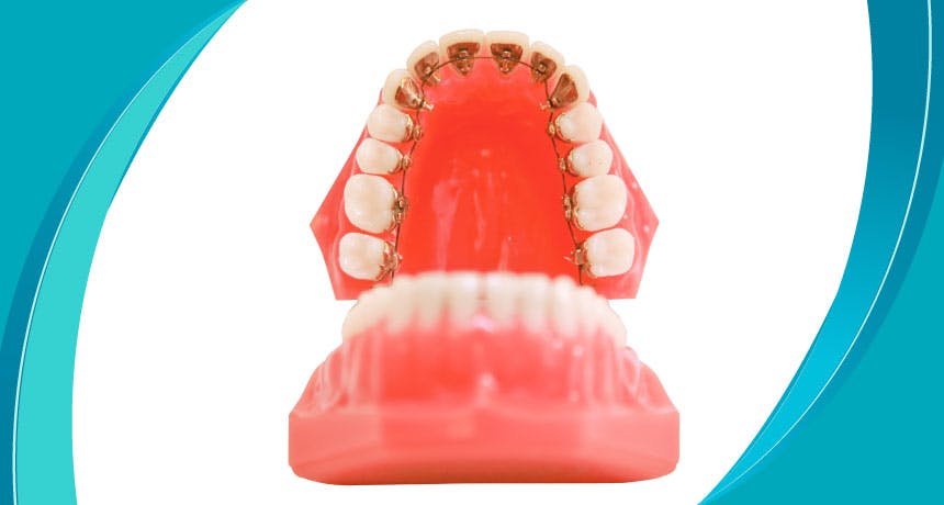 ما هو تقويم الأسنان اللساني (تقويم الأسنان غير المرئي)؟