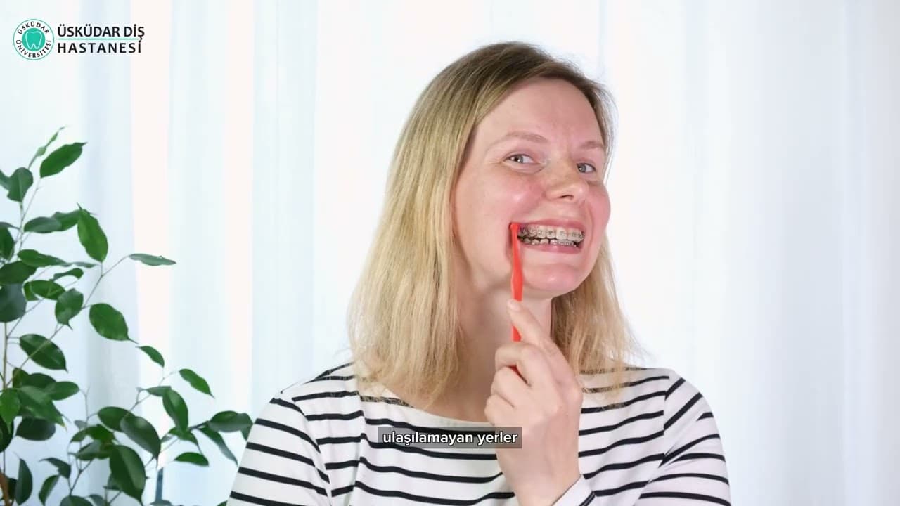 Diş Teli Kullanımında Diş Bakımı Nasıl Yapılır?-thumbnail