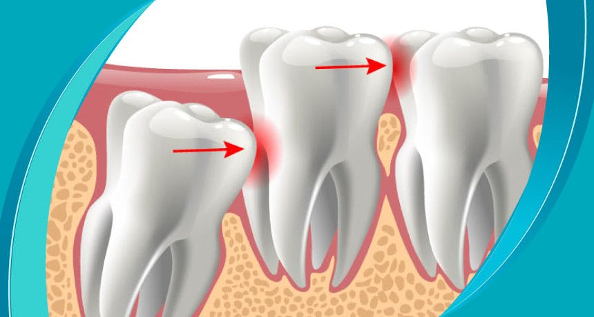 What is a Wisdom Tooth? Wisdom Tooth Symptoms