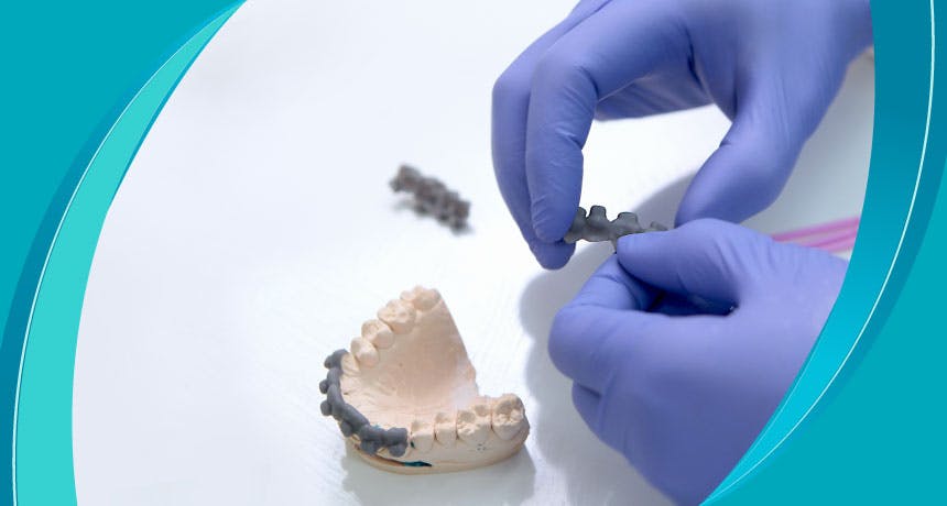 What is Teeth Bonding?