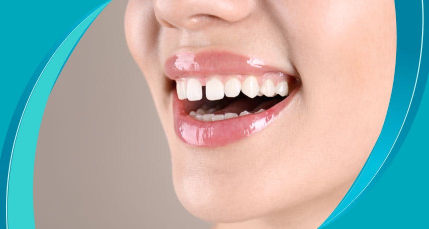 Что такое диастема (раздвоенный зуб)?