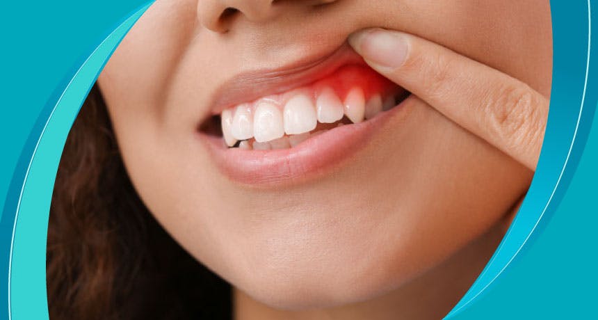 Что такое абсцесс зуба?  