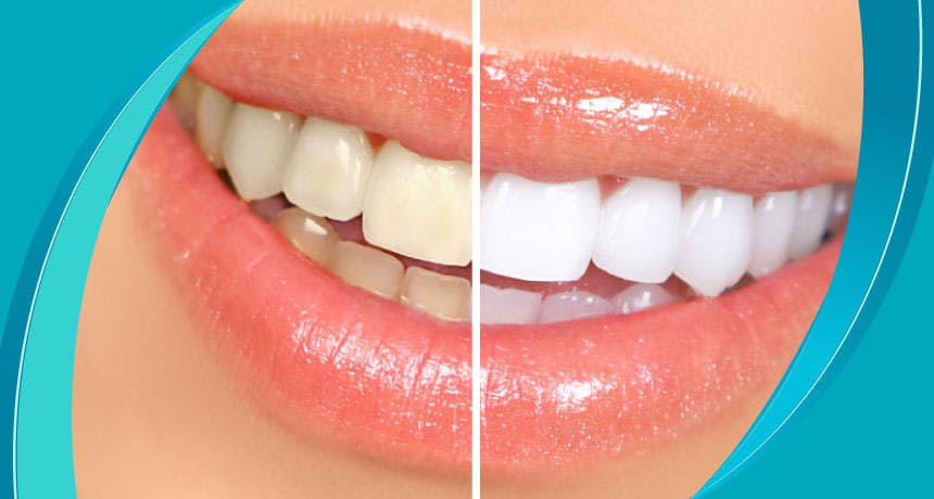 Методы отбеливания зубов  