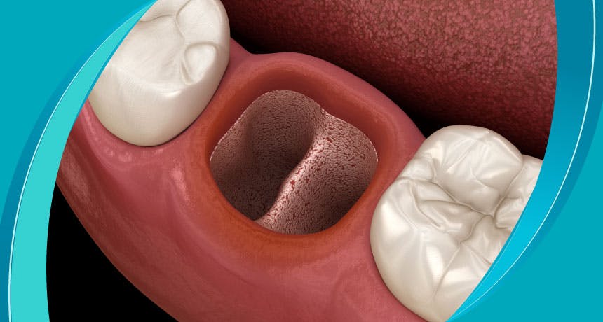 Diş Çekimi Sonrası İltihaplanma (Alveolit) Nedir?  