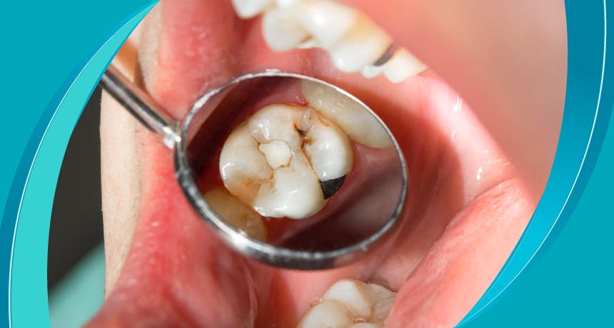 ما هو تسوس الأسنان؟ كيف تعالج تسوس الأسنان؟