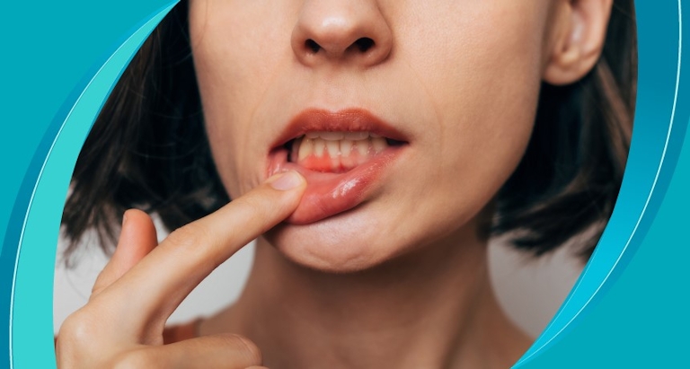 Diş Eti Çekilmesi (Periodontitis) Nedir? Nasıl Tedavi Edilir?  