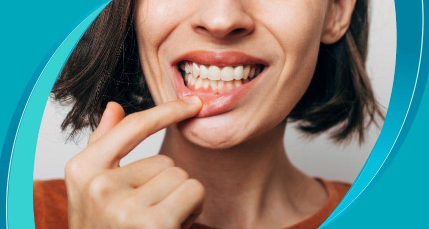 What is Gingival Inflammation?