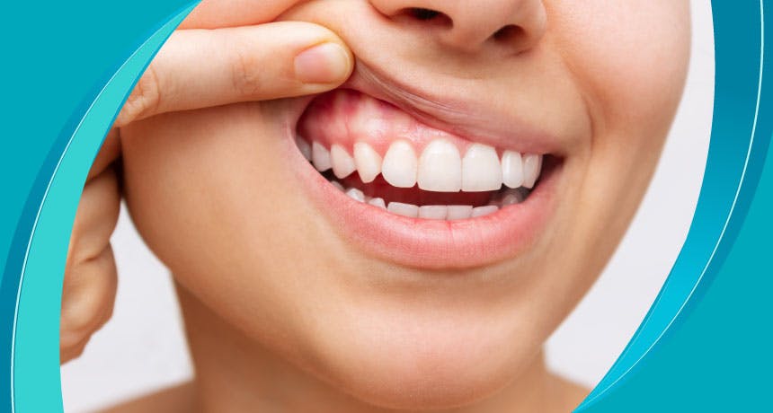 Diş Eti Tedavisi Nedir?