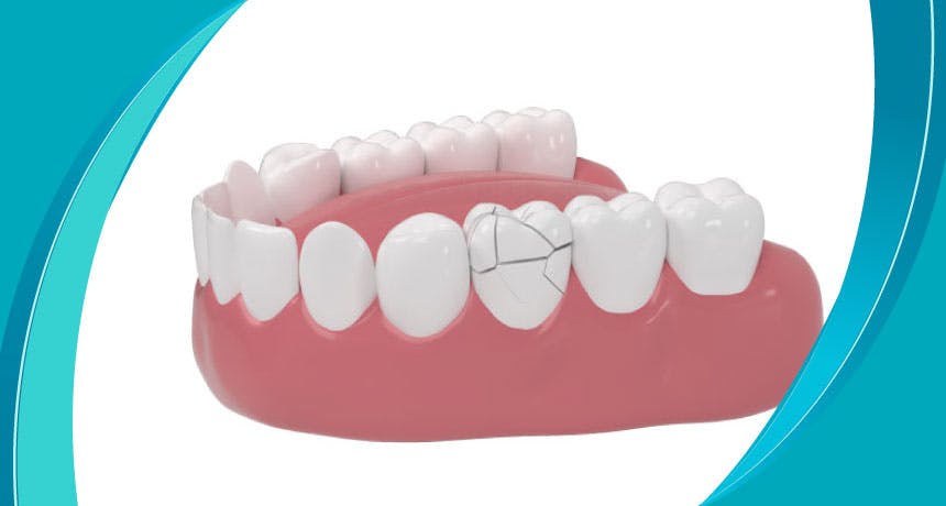 Почему возникает перелом зуба?  