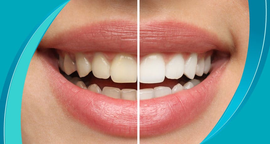 What are Tooth Stains?