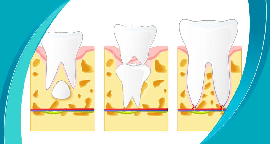 Diş Rezorpsiyonu (Yaralanması) Nedir?