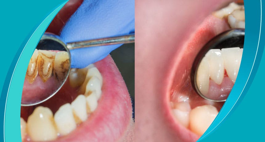 ما هو قلح الأسنان؟ لماذا يحدث قلح الأسنان؟  