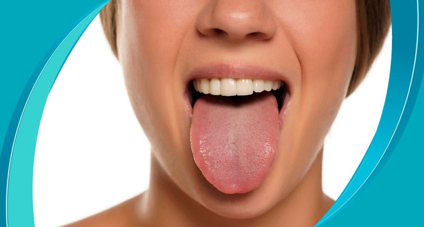 What is Hairy Tongue Disease?