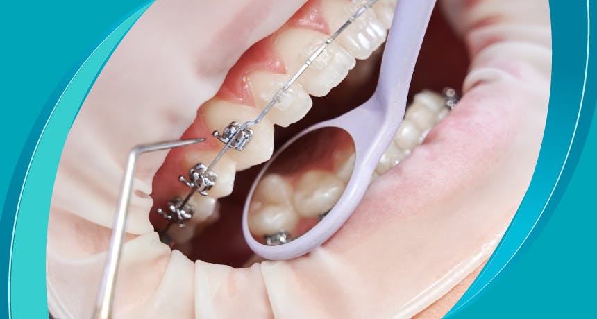 لماذا تحدث مشاكل تقويم الأسنان؟  