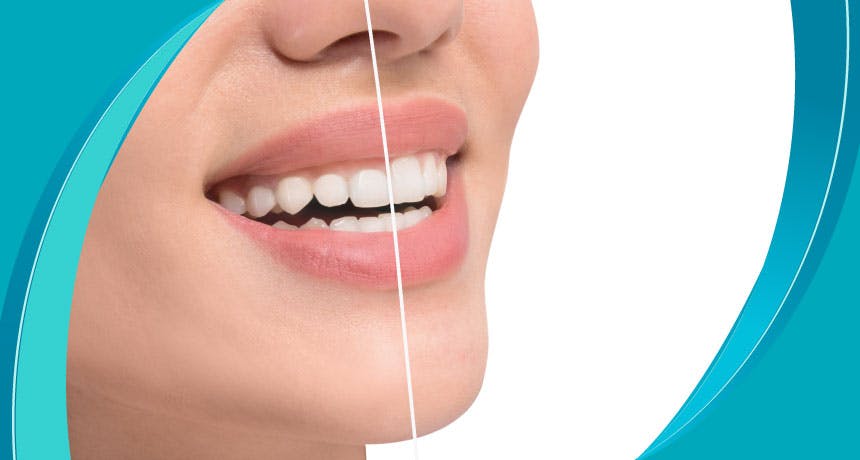 What is Plastic Periodontal Therapy?