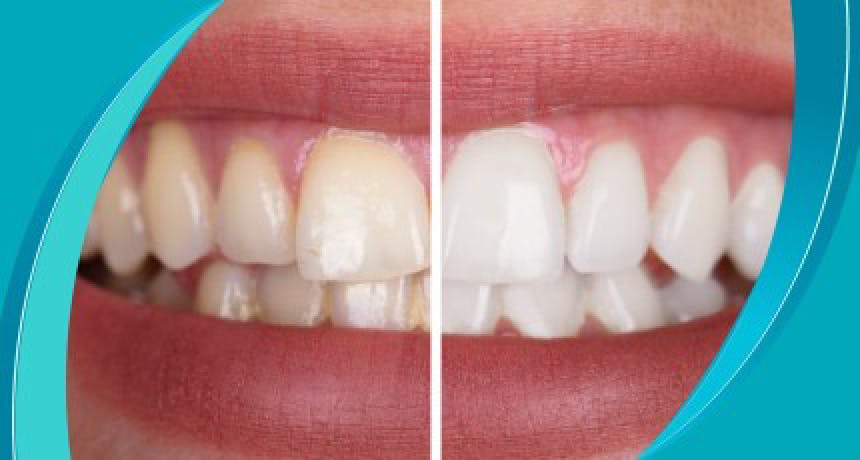 Восстановительное лечение зубов